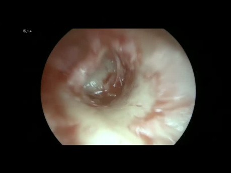 Endoskopische Typ-I-Knorpeltympanoplastik
