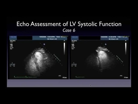 Ein praktischer Ansatz zur linksventrikulären Ejektionsfraktion (LVEF) mittels Echokardiographie