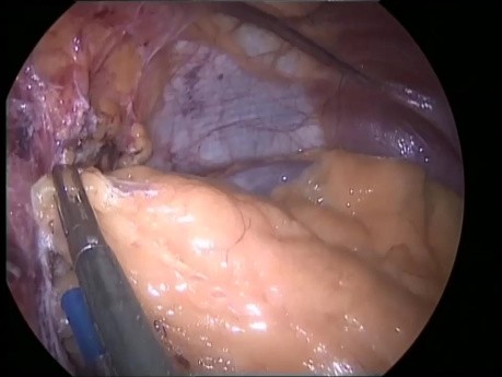 Omentoplastik mit nebulisiertem Glubran 2 bei Schlauchmagen-Operation.