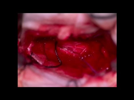 Intradural Sequestrierter Bandscheibenvorfall
