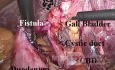Cholezystoduodenale Fistel