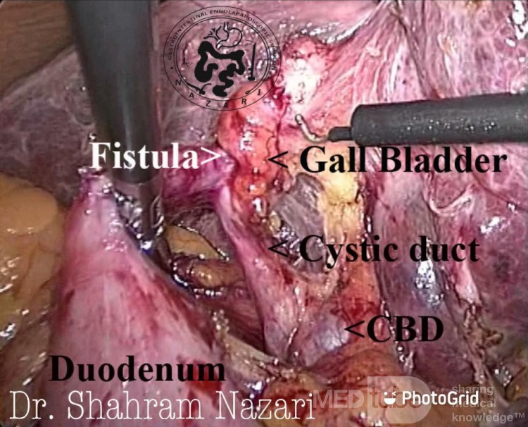 Cholezystoduodenale Fistel