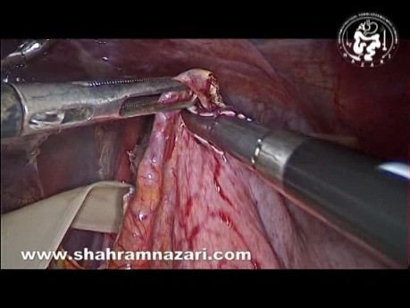 Laparoskopische Heller-Myotomie