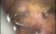 Robotische totale mesorektale Exzision – praktische Lösung