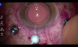 Amnionmembran-Transplantatchirurgie bei persistierendem Makulaloch