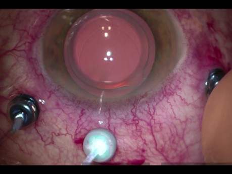 Amnionmembran-Transplantatchirurgie bei persistierendem Makulaloch