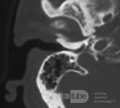 CT- Bild der Exostose des äußeren Gehörgangs