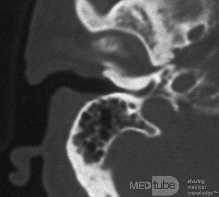 CT- Bild der Exostose des äußeren Gehörgangs