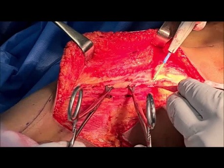 Latissimus-Dorsi-Klappe