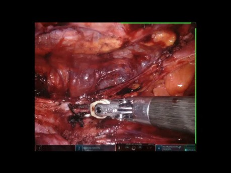 Keimzelltumor - nach der Chemoterapie