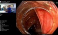 Polyp-EMR (endoskopische Mukosaresektion)