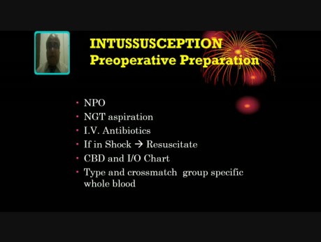 Invagination