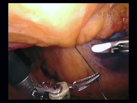 Robotische TAPP-M2-3-W1-Rekonstruktion einer medianen Hernie mit Standard-Lateral-Docking