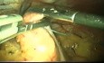 Konventionelle Laparoskopie zur laparoskopische Einzelzugangchirurgie