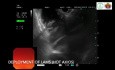 Maligne Obstruktion des Afferent-Loop-Syndroms, behandelt mit EUS-gesteuerter LAMS-Gastrojejunostomie