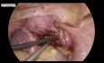 Laparoskopische Myomektomie-  ein Myom an der hinteren Wand des Uterus und Endometriose
