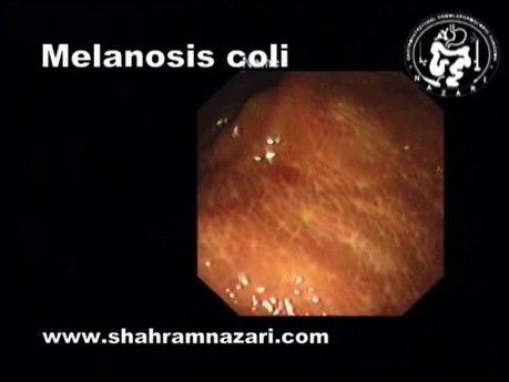 Melanosis coli