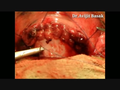 Kaiserschnitt unter Lokalanästhesie - Dr.Avijit Basak