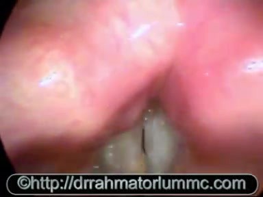 Zyste an der Stimmlippe mit Reinke-Ödem und pharyngolaryngealem Reflux