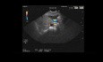 Endoskopischer Ultraschall eines Gallengangssteins mit normalem Gallengangsdurchmesser