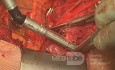 Vorhofresektion bei nicht-kleinzelligem T4-Lungenkrebs mit Beteiligung des linken Vorhofs