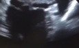 Riesiger Thrombus im linken Vorhof