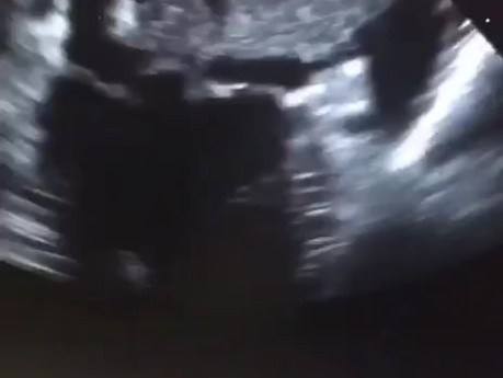 Riesiger Thrombus im linken Vorhof