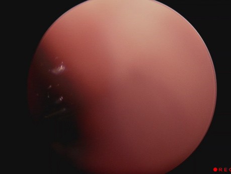 Akute Epiglottis mit Abszessbildung