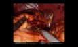 Robotergestützte Gastrektomie, Splenektomie und distale Pankreatektomie bei einem gastralen Tumor.
