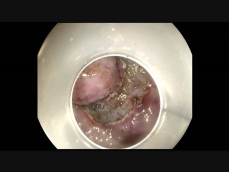 Endoskopische Resektion des gastrointestinaler Stromatumor 