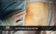 Notfallmäßige Femoralhernie
