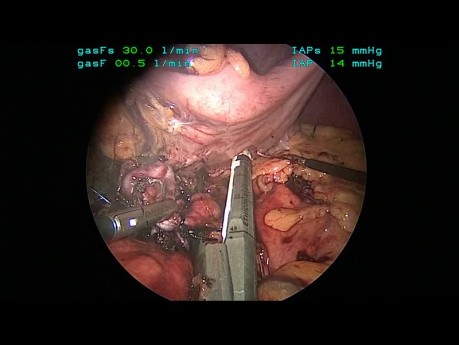 Laparoskopische Resektion der Arteria splenica zur Behandlung von 4 Aneurysmen