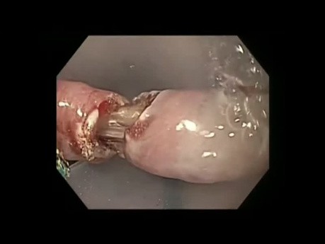 Endoskopische Behandlung des Zenker-Divertikels