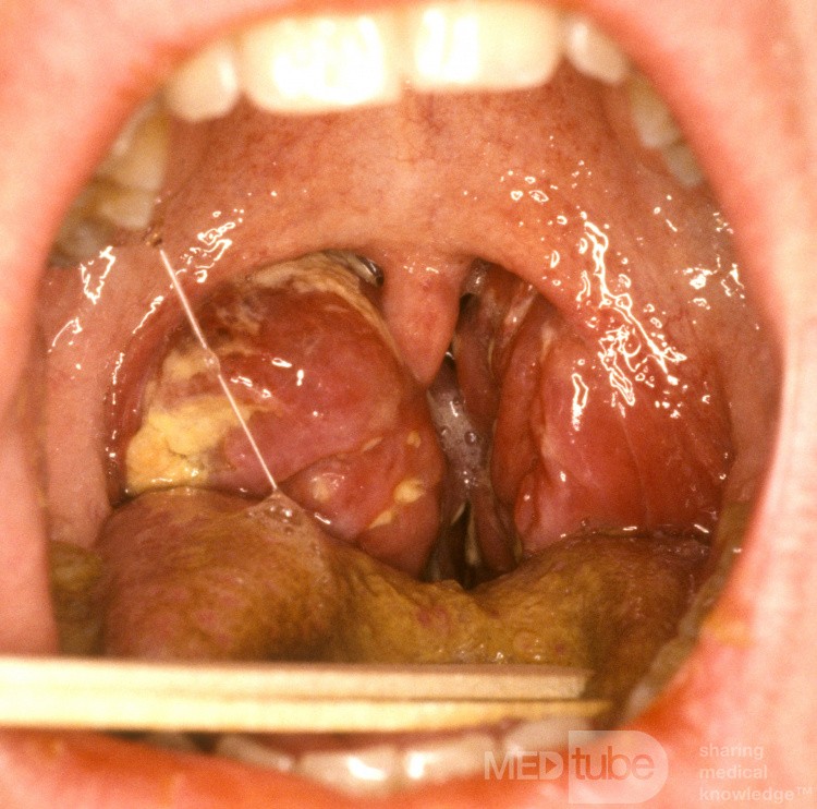 Mononukleose-Tonsillitis mit Atemwegsobstruktion