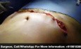 Lipoabdominoplastik
