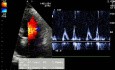 Ein Patient mit Bluthochdruck. Das EKG, das Echokardiogramm und die linksventrikuläre diastolische Funktion