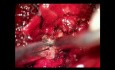 Paravertebraler Tumor der Brustwirbelsäule