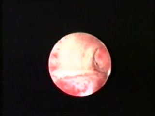 Osteoide Metaplasie- Hysteroskopie