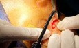 Osteom im nasoethmoidalen Bereich
