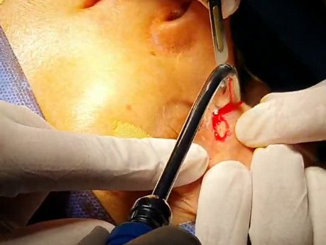 Osteom im nasoethmoidalen Bereich