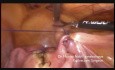 Retroflexio uteri- laparoskopische Chirurgie