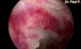 Hysteroskopische Endometriumresektion