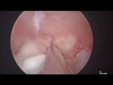 Entfernung von Endometriumpolypen - Polypektomie