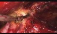 Laparoskopische TEP-Reparatur der Nabelschnurhernie