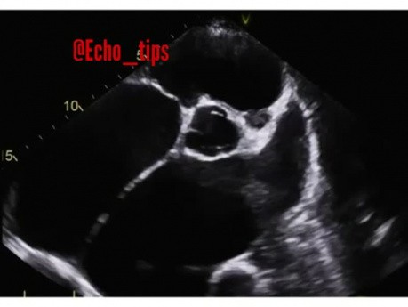 10. Was sehen Sie in der Echokardiographie?