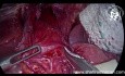 Laparoskopische Heller-Kardiomyotomie bei rezidivierender Achalasie: Ist eine laparoskopische Operation machbar?