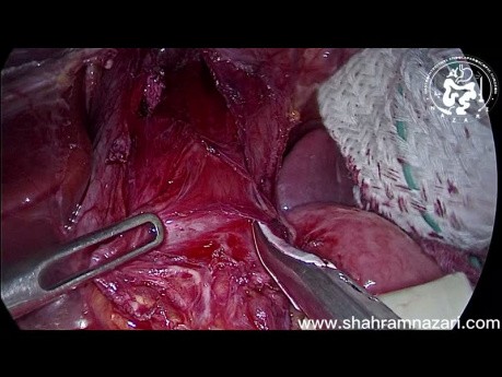 Laparoskopische Heller-Kardiomyotomie bei rezidivierender Achalasie: Ist eine laparoskopische Operation machbar?