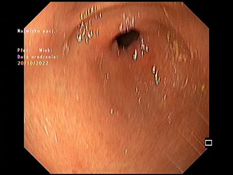 Submuköser Tumor?