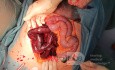 Viszeralvenenthrombose