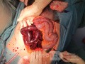 Viszeralvenenthrombose
